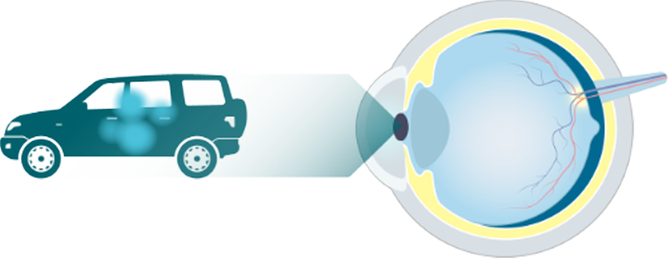 Eye diagram looking at a car with an illustration of visual impairment due to early/intermediate AMD