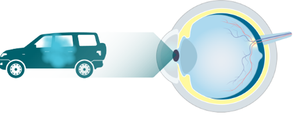 Eye diagram looking at a car with an illustration of visual impairment due to GA
