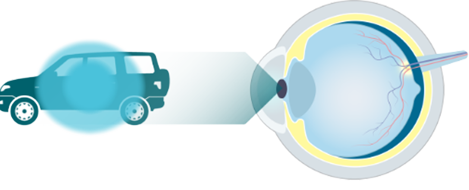 Eye diagram looking at a car with an illustration of visual impairment due to wet AMD